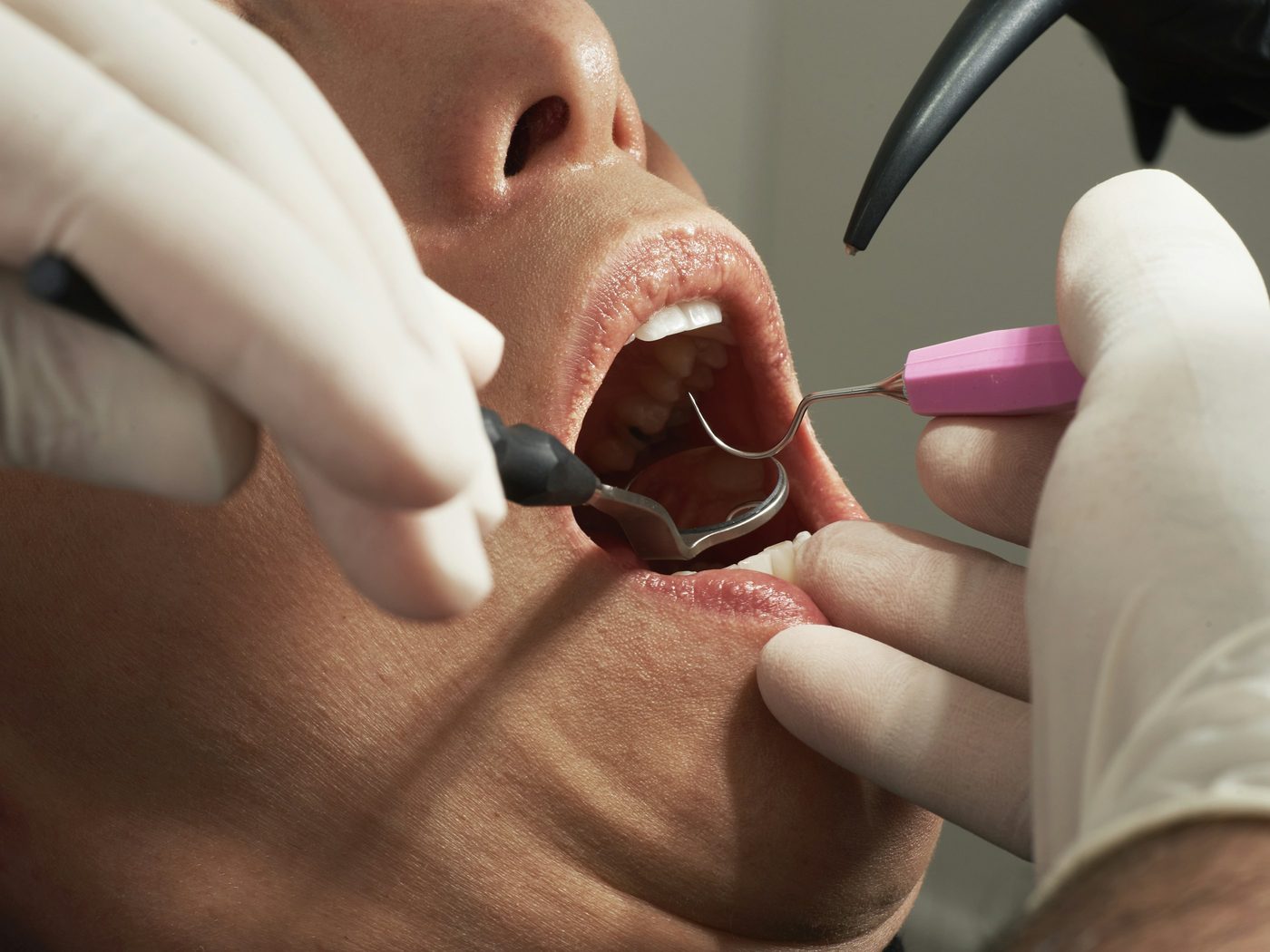 A dentist repairing a damaged tooth during restorative treatment